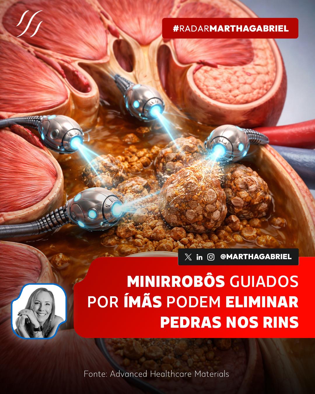 Minirrobôs guiados por ímãs podem dissolver pedras nos rins